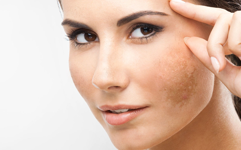 Um medo chamado Melasma Um medo chamado Melasma